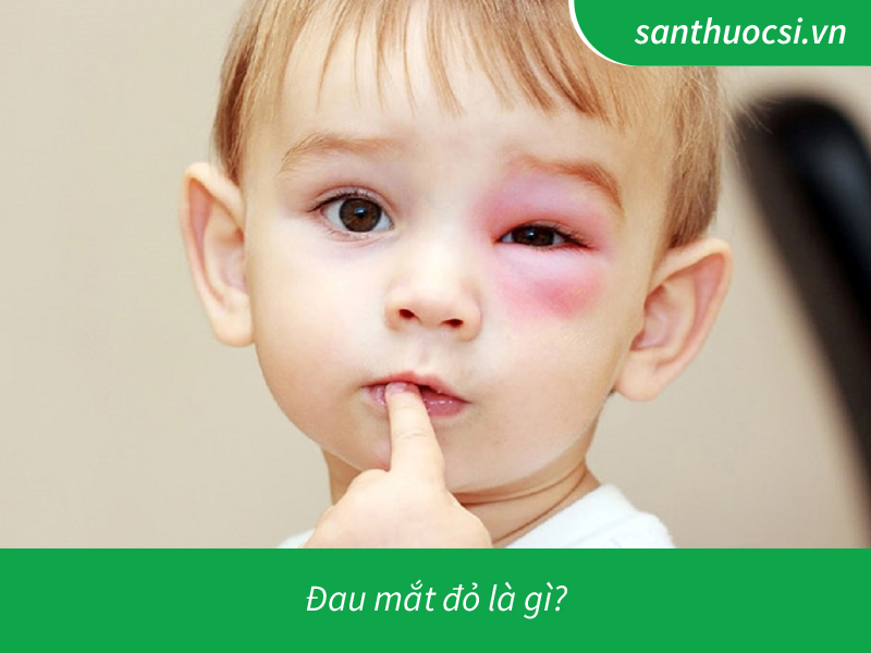 Đau mắt đỏ là gì?