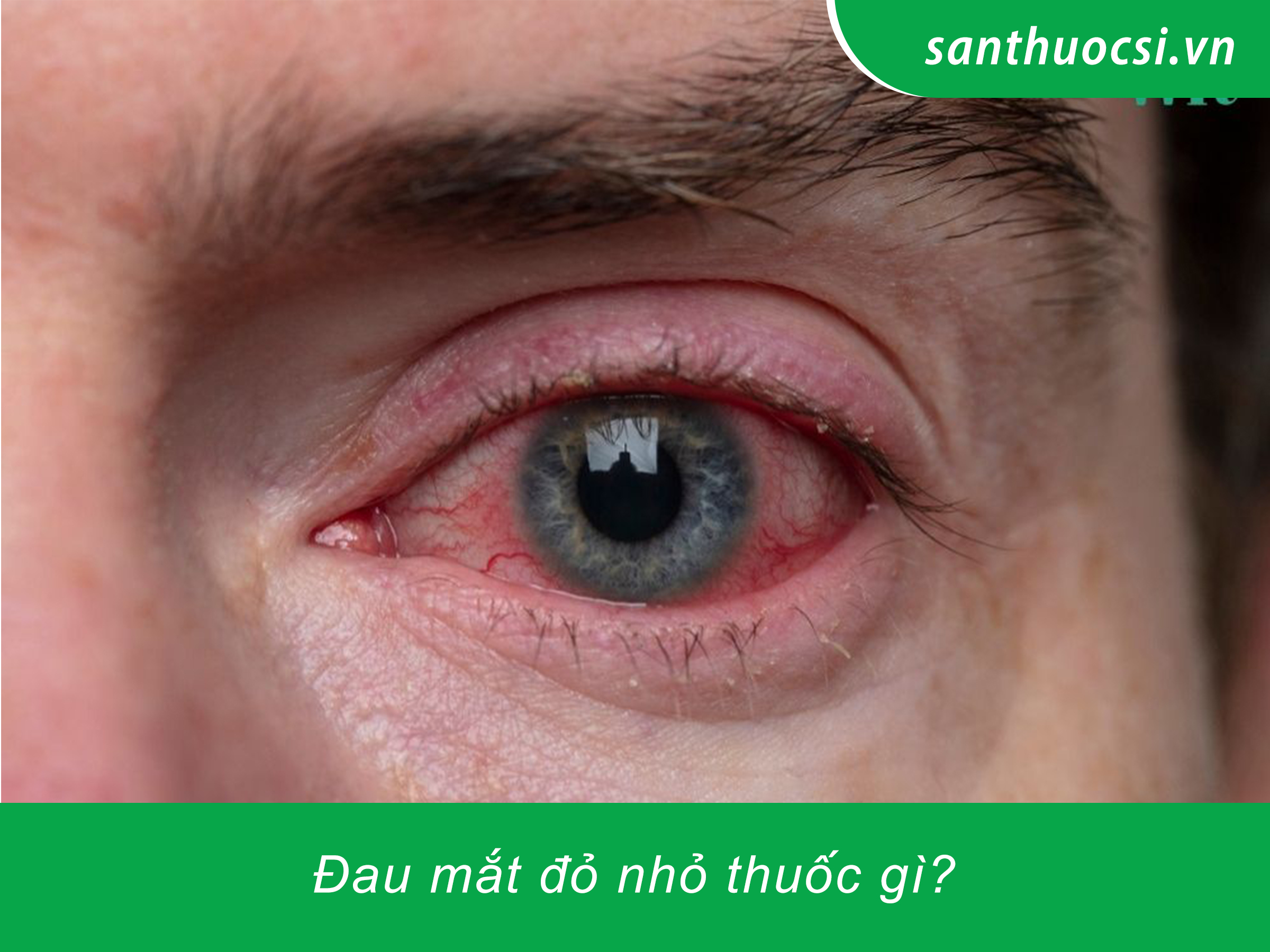 Đau mắt đỏ nhỏ thuốc gì?