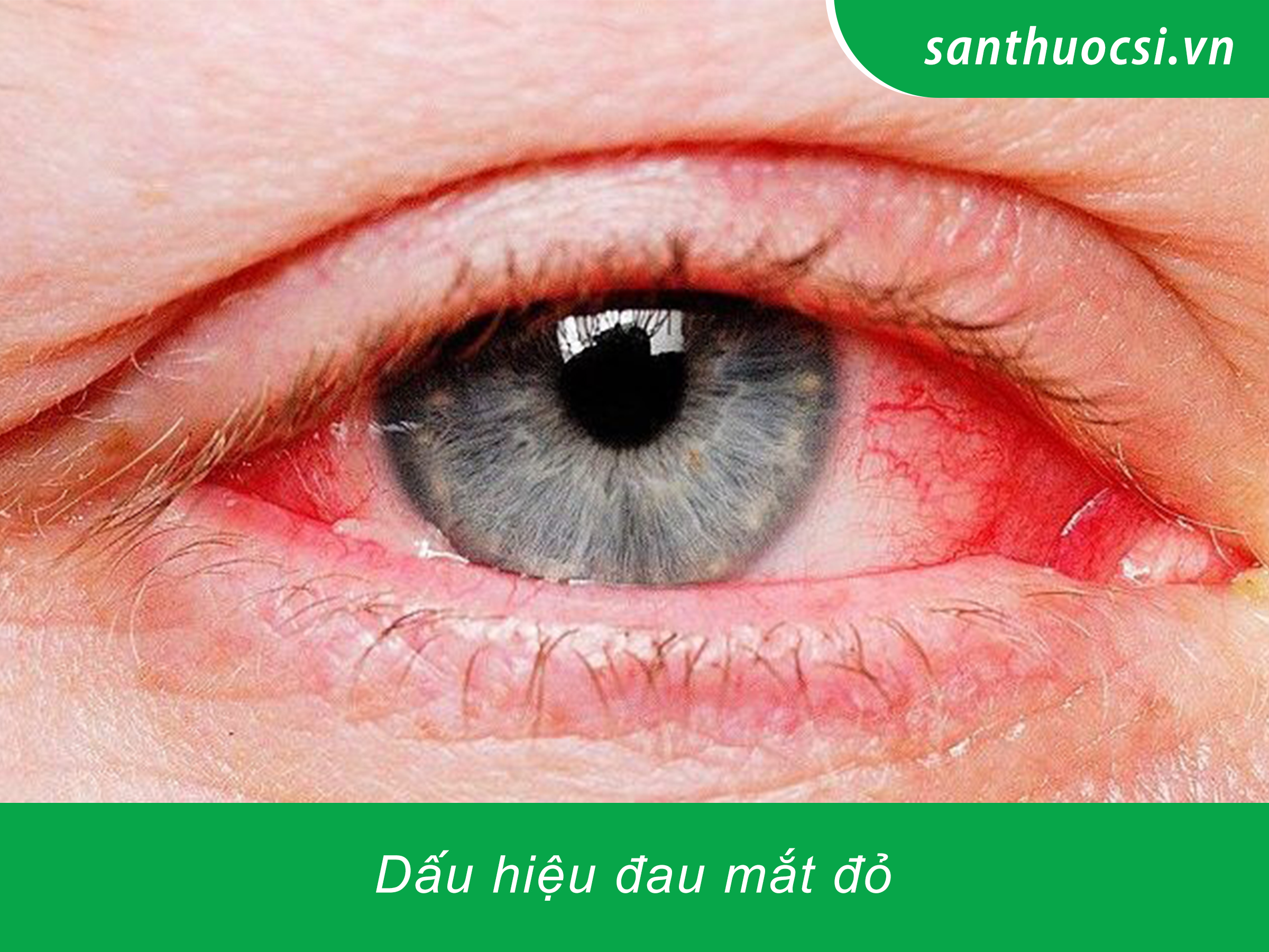 dấu hiệu đau mắt đỏ