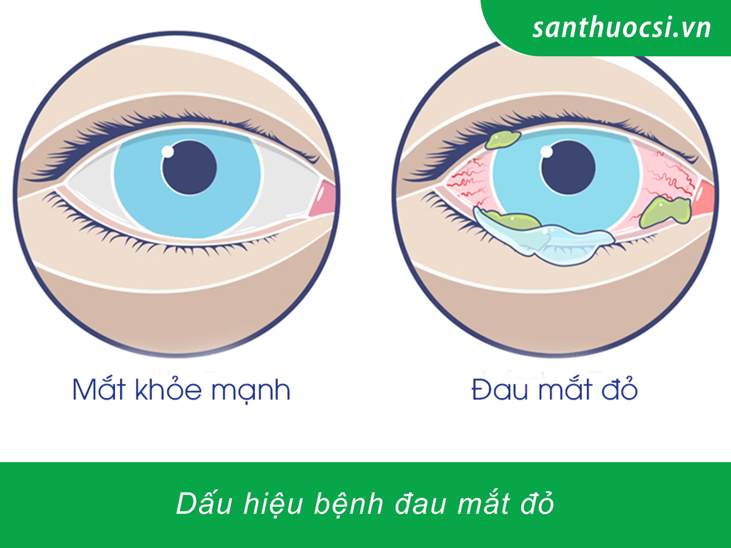 Dấu hiệu bệnh đau mắt đỏ